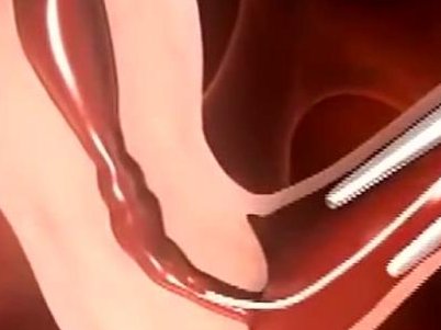 山东大学齐鲁医院三代试管移植两个胚胎能生一对多胎吗？